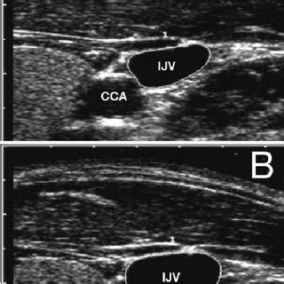 Ultrasound Validation Of Maneuvers To Increase Internal Jugular Vein