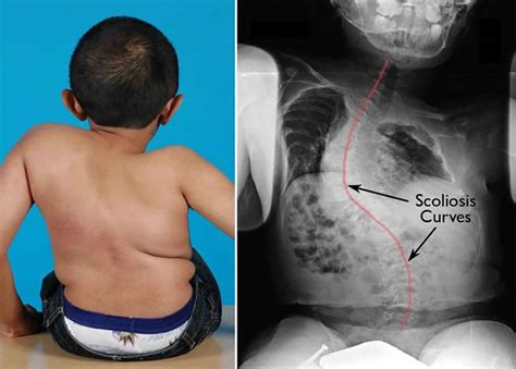 Osteogenesis Imperfecta Type 1