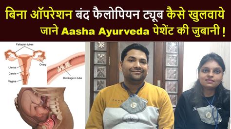 बिना ऑपरेशन Blocked Fallopian Tubes कैसे खुलवाये जाने Aasha Ayurveda