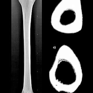 Im Genes Radiogr Ficas Y Tomogr Ficas De La Tibia De Puesto Pescador