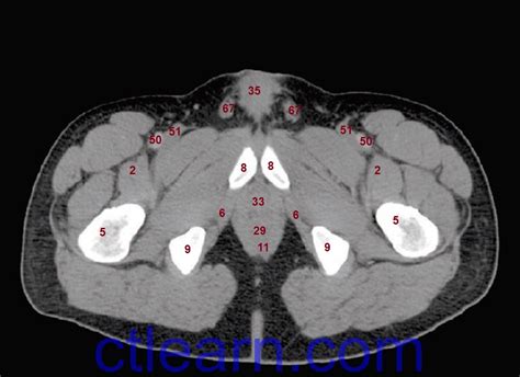 Learn Ct Scan Anatomy Ct Axial Abdomen And Pelvis Male