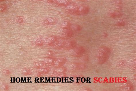 Home Remedies for Scabies