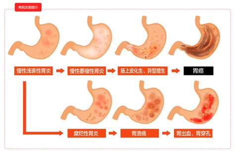 从胃炎到胃癌，我们的胃经历了什么？胃炎胃癌经历幽门螺旋杆菌萎缩性胃炎上皮内瘤变癌变 健康界