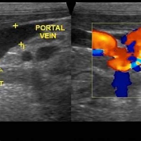 Color Doppler Ultrasonography Showing Shunting Vessel With Turbulent