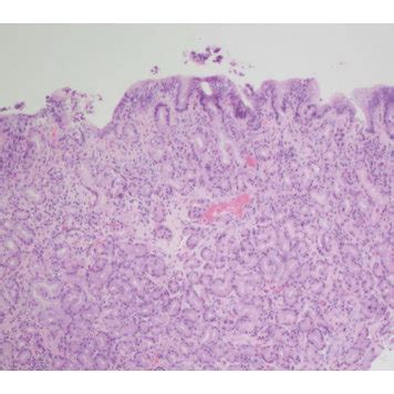 (a) 4x magnification of the results of upper endoscopy biopsy showing ...