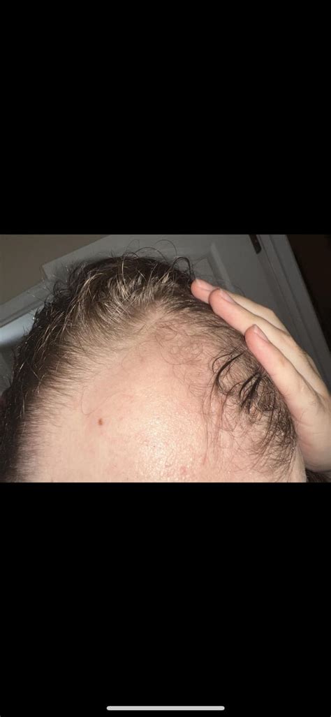 2 months of minoxidil : r/minoxidil