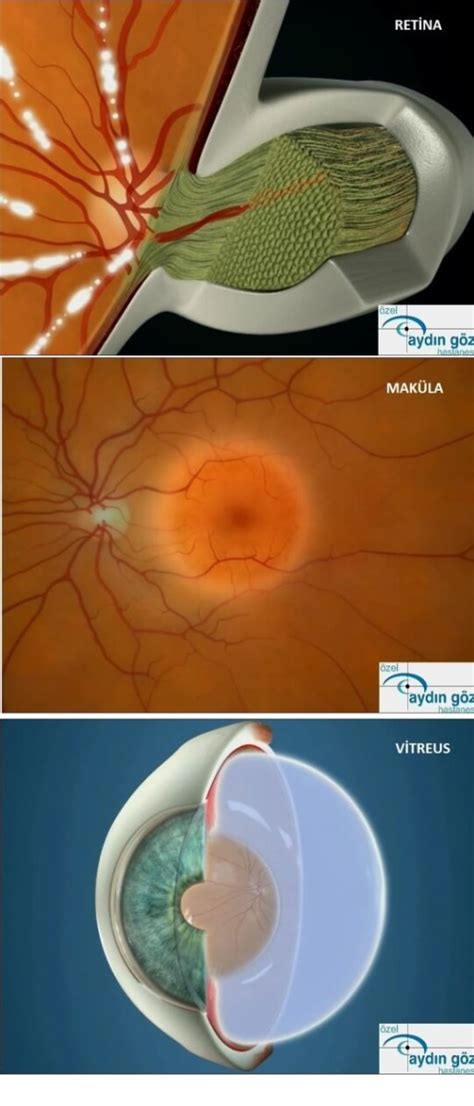 Vitreus Maküla ve Retina Nedir Özel Aydın Göz Hastanesi