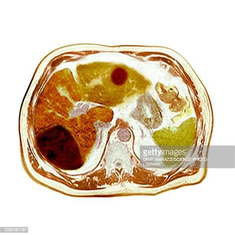 Ct Scan Liver Stock Fotos Und Bilder Getty Images