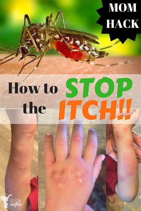 Mosquito Bites Are Not Fun Here Is How To Stop The Itch Great Mom