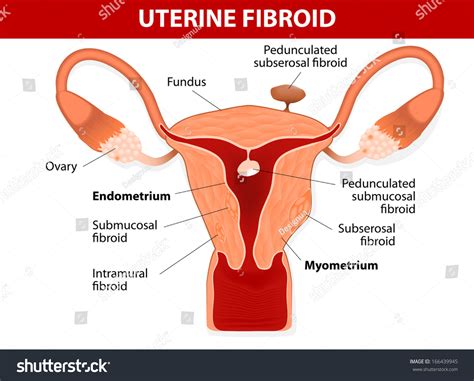 671 Uterine Fibroid Female Images Stock Photos Vectors Shutterstock