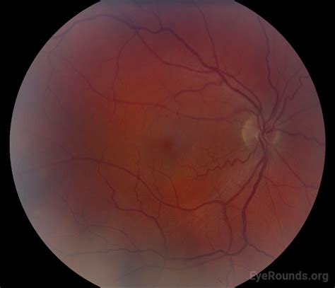 Atlas Entry Non Arteritic Anterior Ischemic Optic Neuropathy Naion