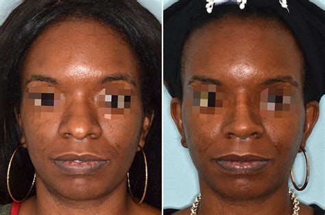 Ethnic Rhinoplasty Photos Miami Fl Patient