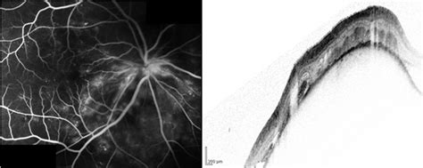 Fluorescein Angiogram And Corresponding Spectral Domain Optical Download Scientific Diagram