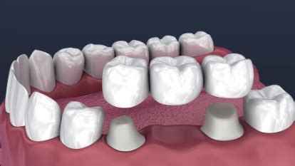 Understanding The Dental Bridge Cost In Australia A Comprehensive Guide