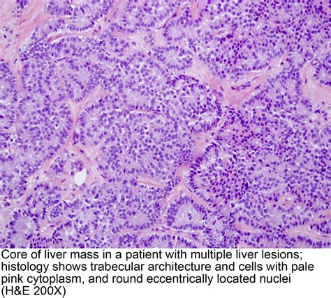 Pathology Outlines Well Differentiated Neuroendocrine Tumor WHO Grade