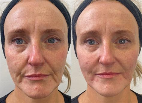 Dermal Fillers Gold Coast Visage Mediclinic