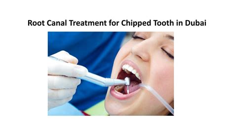 Ppt Root Canal Treatment For Chipped Tooth In Dubai Powerpoint