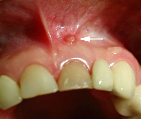 Gum boil, abscess, gingival recession? | Dentalnews (en)