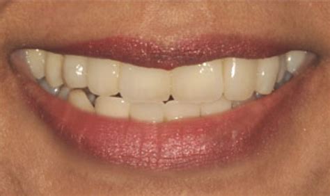 Dental Bridges Before and After Pictures in Kinston, NC