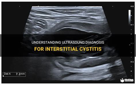 Understanding Ultrasound Diagnosis For Interstitial Cystitis Medshun