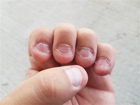 Nail Biting Nail Biting Damages How To Stop Nail Biting