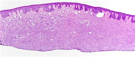 Dermatofibrosarcoma Protuberans Histology