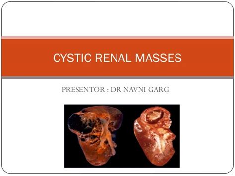 Cystic Renal Masses