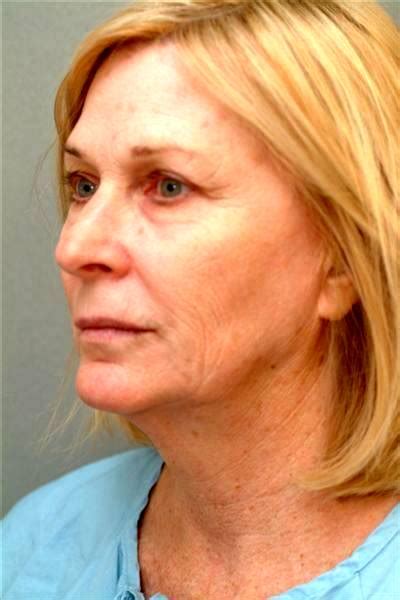 General Or Local Anesthesia Is Used During Full Facelift Facelift Info Prices Photos