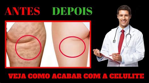 O MELHOR TRATAMENTO PARA ELIMINAR CELULITE Nas Coxas Pernas E Barriga