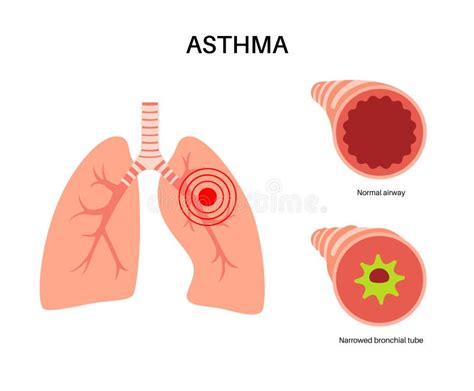 Asthma Lung Disease Stock Vector Illustration Of Muscle 272907081