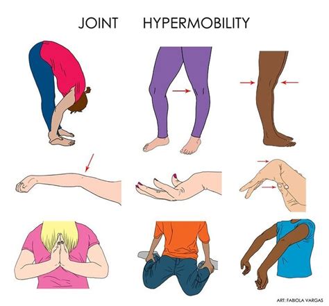 Hypermobility Ehlers Danlos Syndrome Ehlers Danlos Syndrome Hypermobility