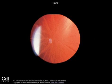 Autosomal Dominant Congenital Cataract Associated With A Deletion