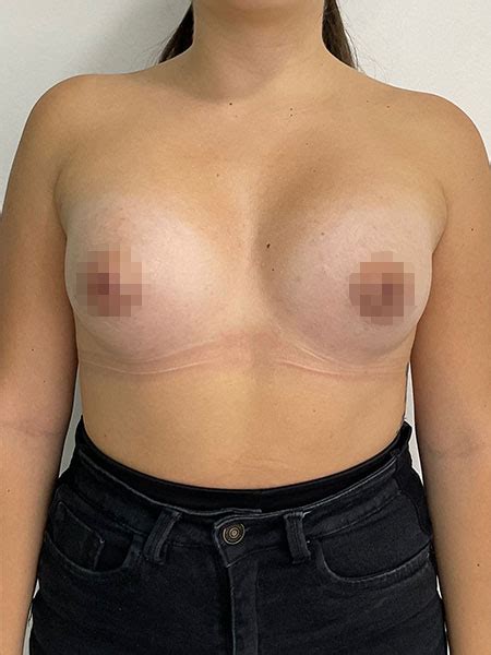 Breast Augmentation Bogota Mammoplasty In Colombia