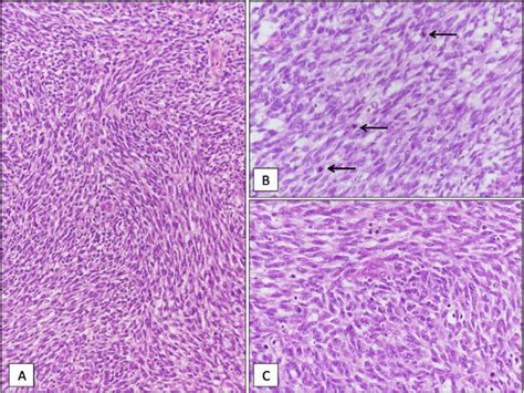 Histological Examination A The Tumor Was Composed Of Closely Packed