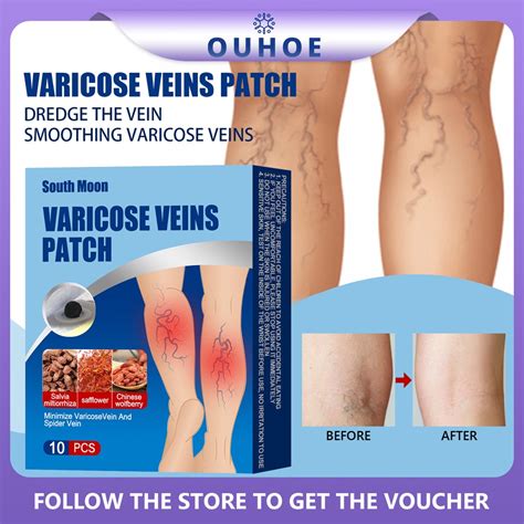 South Moon Varicose Vein Patch Phlebitis Vasculitis Treat Sticker Leg