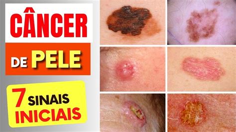 7 SINAIS de Alerta para CÂNCER DE PELE que Todos Deveriam Saber e