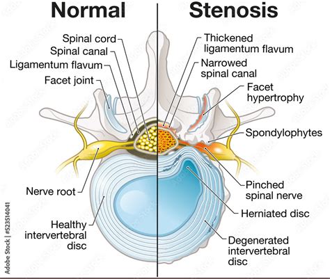 Spinal Canal Stenosis Lumbar Vertebra With Intervertebral Disc And