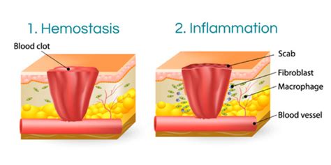 HOW WOUND HEALING WORKS - Scarless Canada