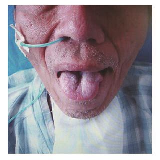 Atrophy and fasciculation of the tongue at the time of diagnosis of... | Download Scientific Diagram