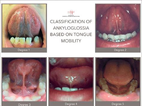 Degrees Of Ankyloglossia Classification Download Scientific Diagram