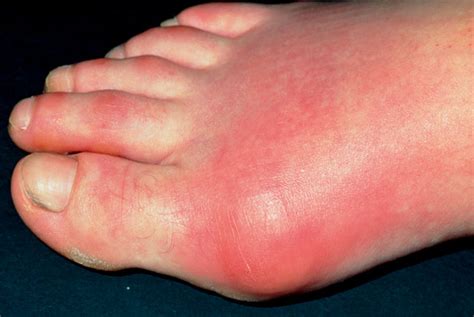 Gout Link To Diabetes Prompts Call For Aggressive Gp Management Gponline