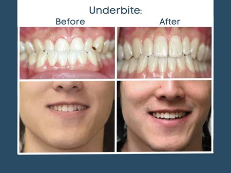 Underbite Before And After Braces