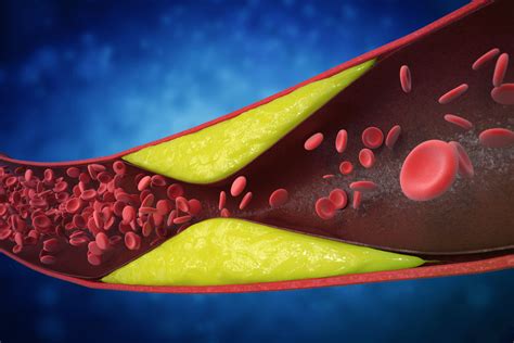 arteriosclerosis atherosclerosis supreme vascular