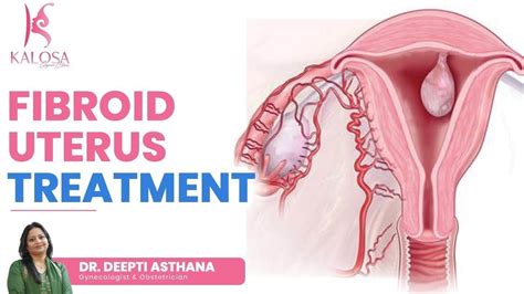 Uterine Fibroids कैसे Treat करें Uterine Fibroid Treatment Options In Hindi Dr Deepti