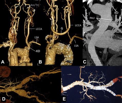 Hybrid Repair Of Penetrating Aortic Ulcer Associated With Right Aortic