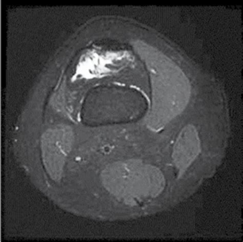 Scielo Brasil Bilateral Localized Pigmented Villonodular Synovitis