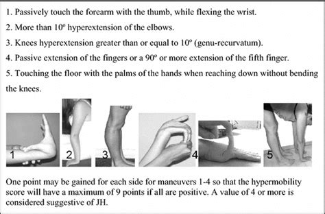 Beighton Score To Identify Jh 1 Download Scientific Diagram