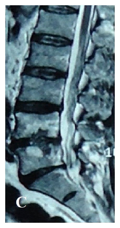 A Discitis And Osteomyelitis Are Seen On This T Weighted Mr Image Of