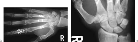 Carpometacarpal Joint Dislocation Musculoskeletal Key