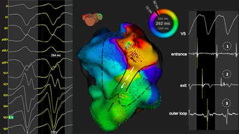 Evaluation Of A Novel High Resolution Mapping System For Catheter